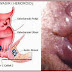 JUAL OBAT WASIR LUAR thumbnail