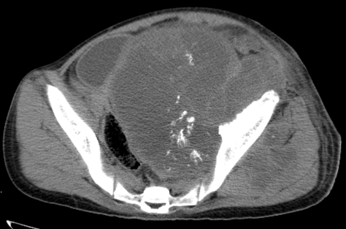 Pelvic Osteosarcoma-CT - Sumer's Radiology Blog