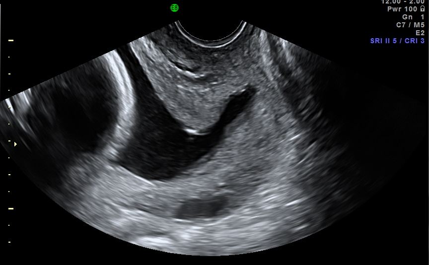 Pregnant in Dubai Preterm birth and cervical length screening in Dubai