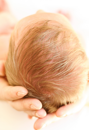 AYUDA MATRONIL ALELU ¿ Qué es la costra láctea?