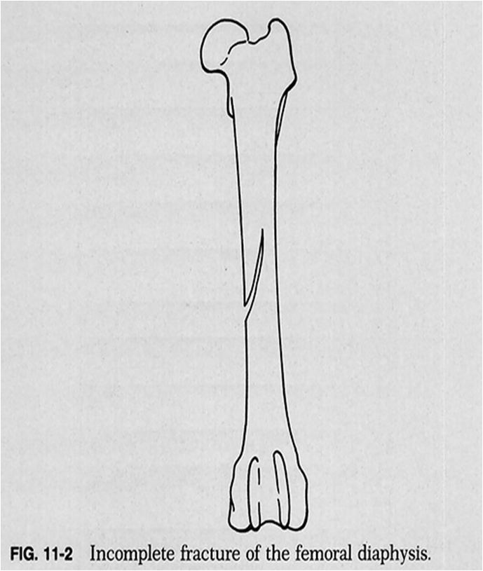 Complete Fracture-4.bp.blogspot.com INCOMPLETE FRACTURE