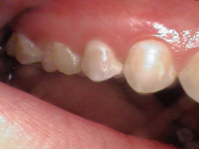 cavity start spot lesions cavities braces perfect hygiene dental queen