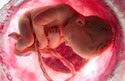 unborn-baby-skeleton-removed-after-36-years-in-inida, womb removed after 36 years