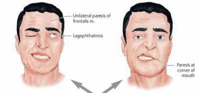 Obat Stroke Ampuh Obat Stroke Ampuh