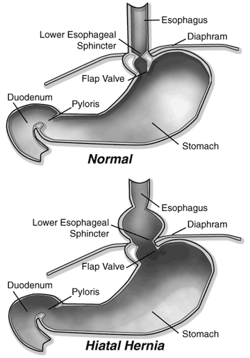 Hiatus Hernia Info: January 2012