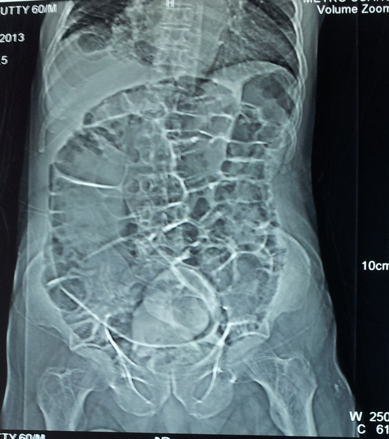 ogilvie syndrome
