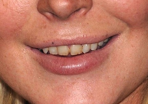 lindsaylohan-teeth2 lindsaylohan-teeth2