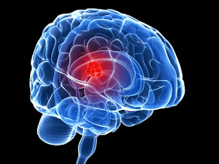 What is brain cancer?