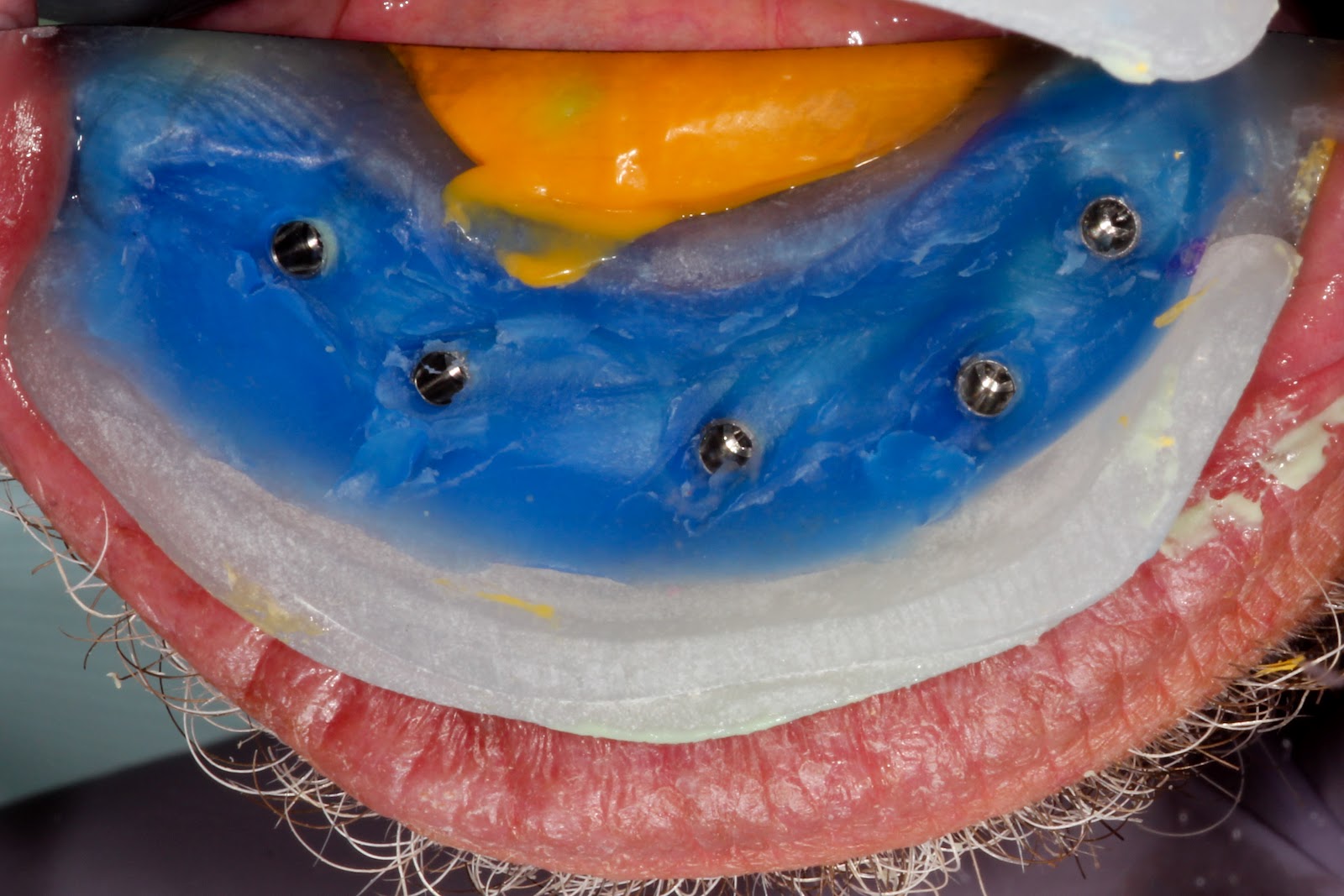 Boise Idaho Prosthodontics Preliminary Mandibular Hybrid Open Tray