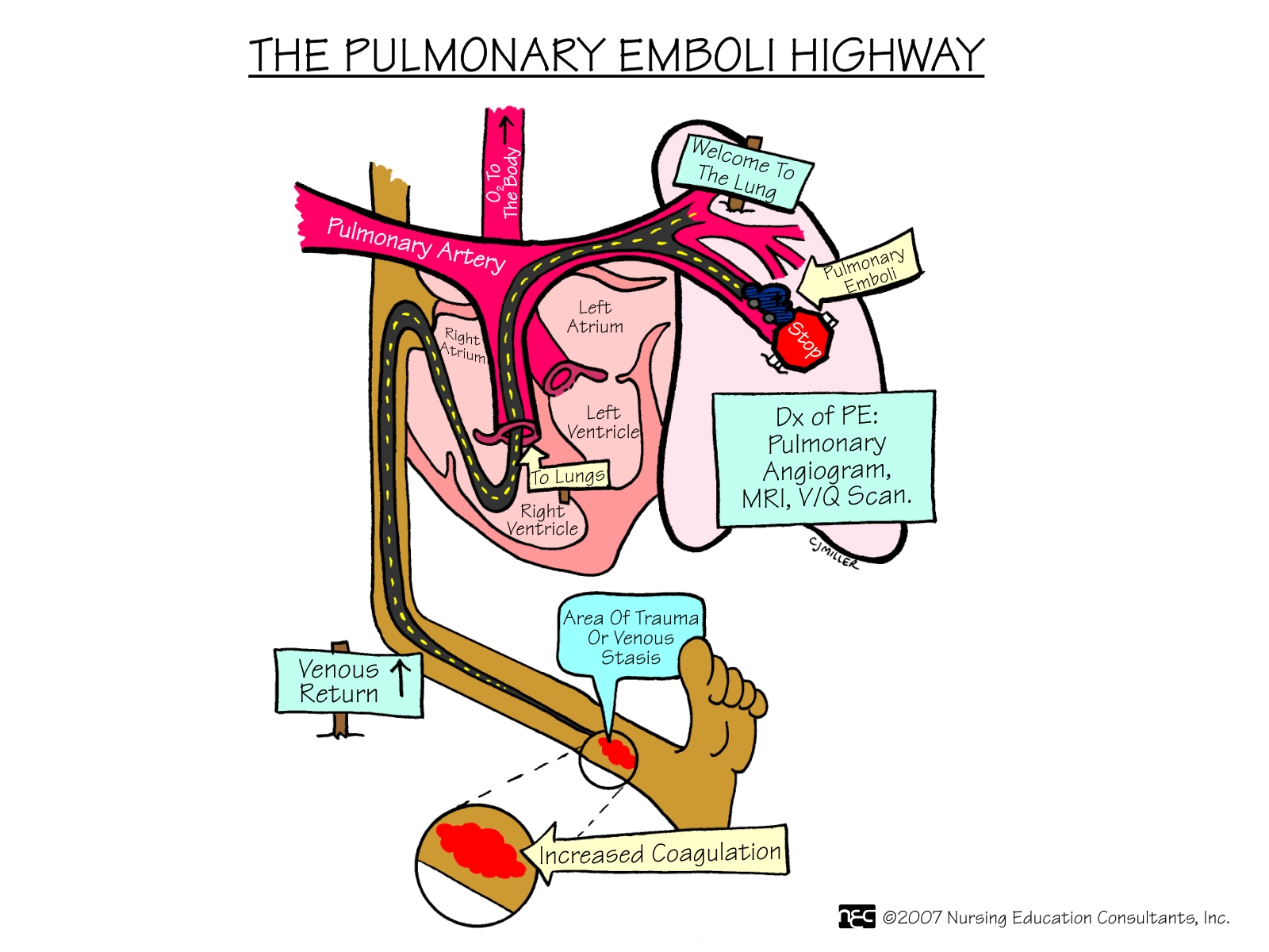 The+Pulmonary+Emboli+Highway. The+Pulmonary+Emboli+Highway