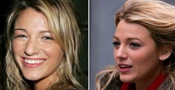 rhinoplasty nose job