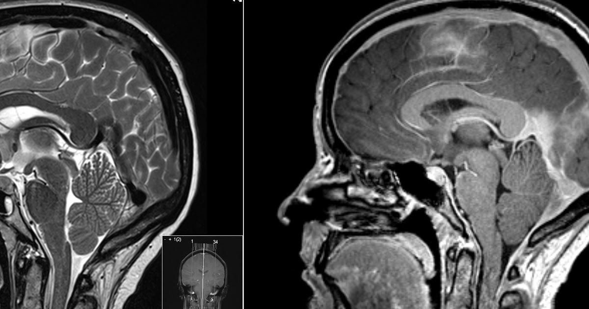 Radiology MRI CSF Leakage Intracranial Hypotension