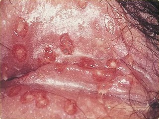 Penyakit Herpes Pada Prempuan