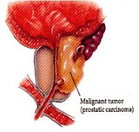 cara ampuh menyembuhkan kanker prostat cara ampuh menyembuhkan kanker prostat