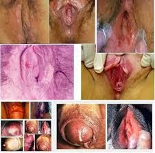 obat sipilis obat sipilis manjur