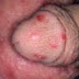 Obat sipilis ampuh tanpa ke dokter thumbnail