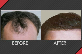 Connect Manila Thinning Hair Problems Going Bald Scalp