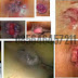 Ada Benjolan Di Anus Dan Sakit Saat BAB thumbnail