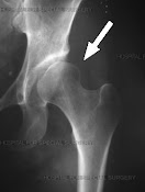 Dysplasia x-ray