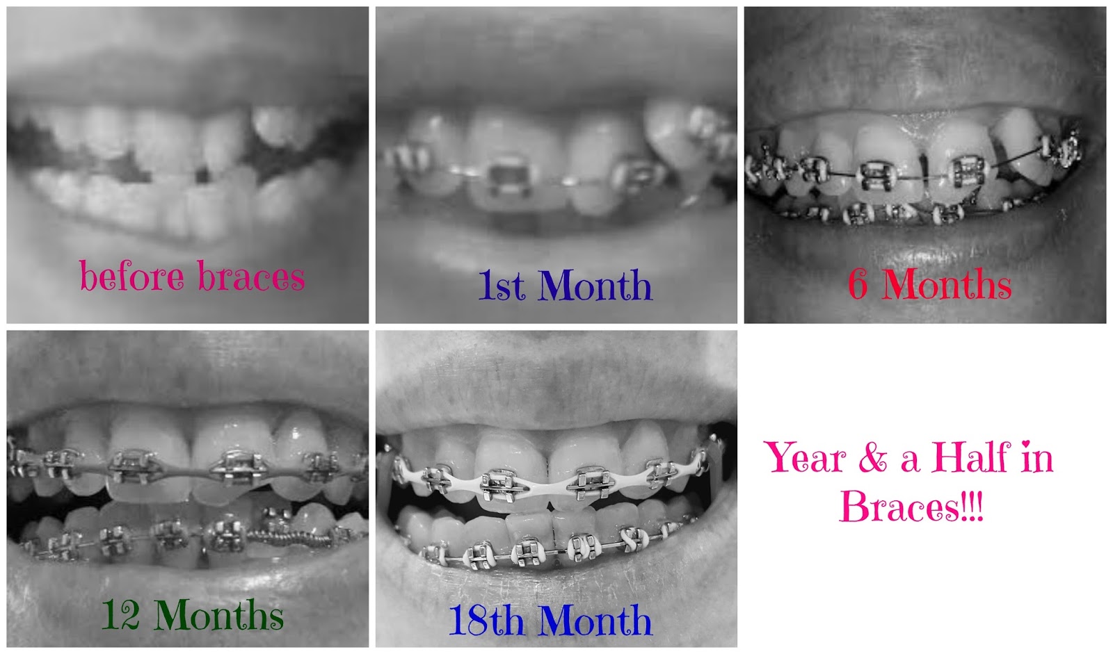 Adult Braces My Journey Year & a Half in Braces!!! Adjustment update!