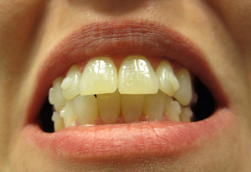 invisalign attachments
