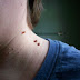 How to Remove Skin Tags Using Home Remedies | Tips to Get Rid of Skin Tags