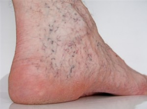 Treatment of Spider Veins and How to Prevent and Cure | Varicose Treatment