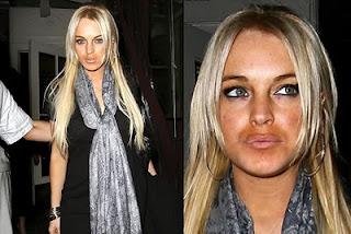 Lindsay Lohan Lips Injections