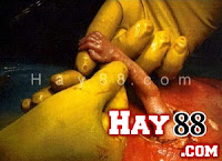 Thai nhi thò tay ra tử cung, nắm tay bác sĩ Thai nhi thò tay ra tử cung, nắm tay bác sĩ