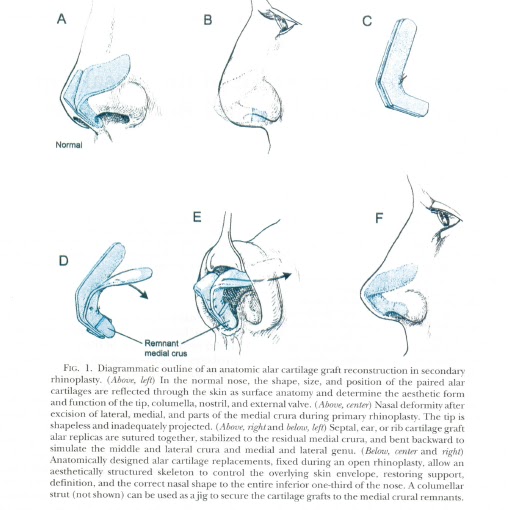 Nose Revision Surgery and Surgeons Anatomic reconstruction of the alar cartilages in secondary