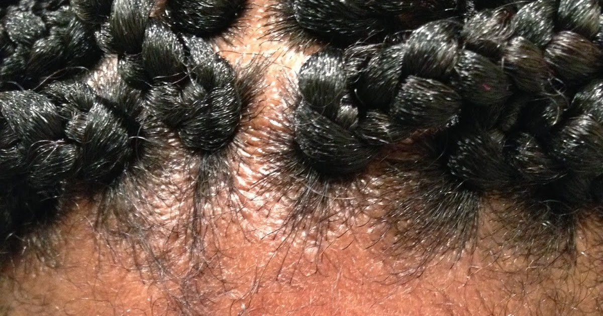 Natural Hair Bumps On Scalp Natural Hair Bumps On Scalp
