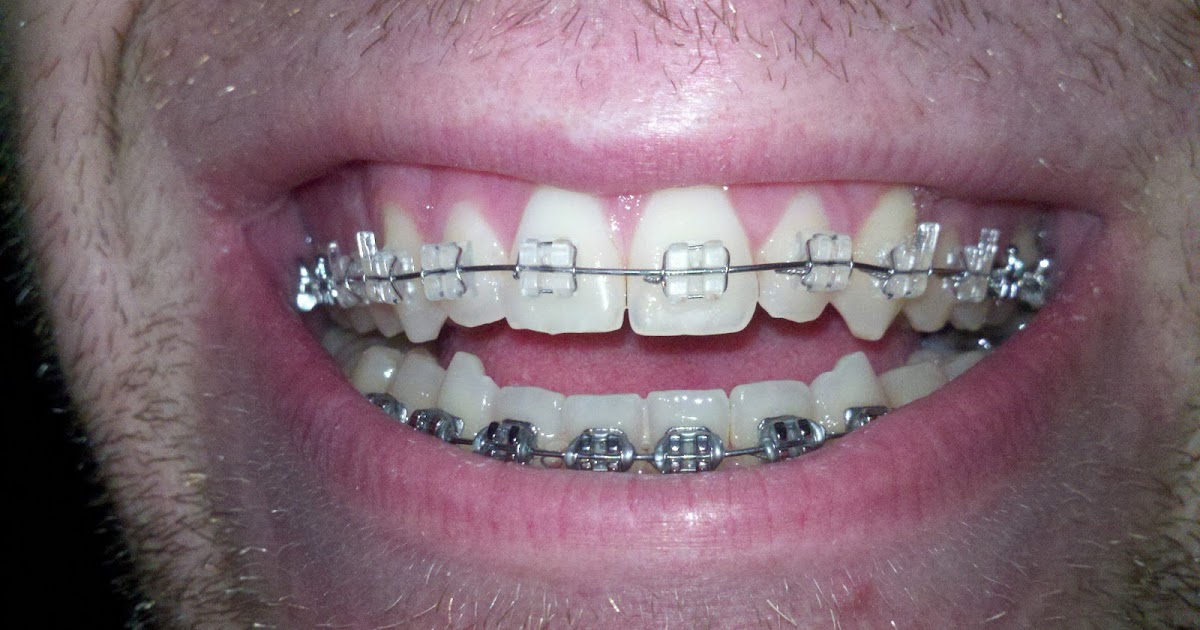 Braces/Open Bite Surgery New pics and quick update