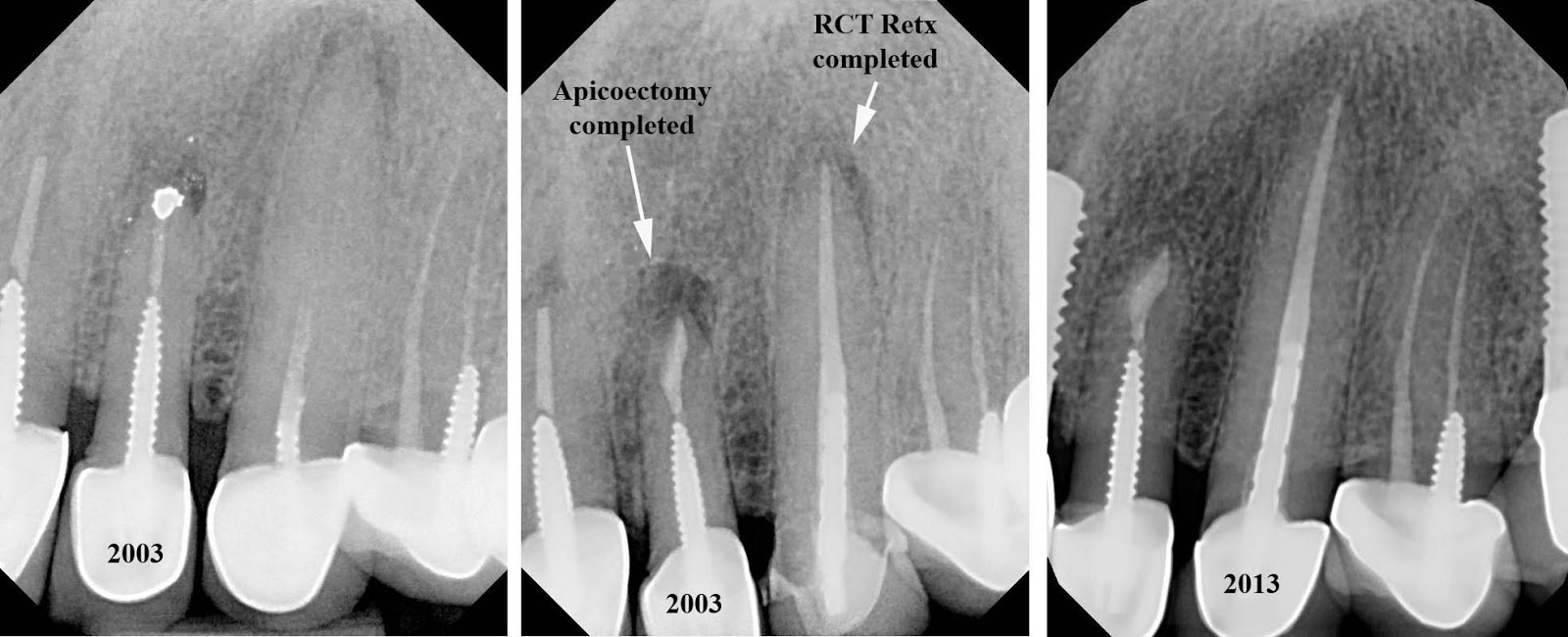 The Endo Blog 10 Yr Success of Apicoectomy & RCT Retreatment