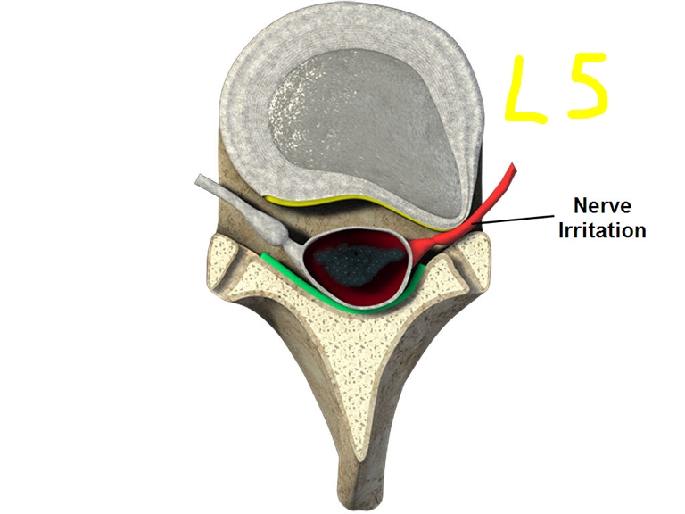 Spinal therapy NYCManhattan's only Patented spinal