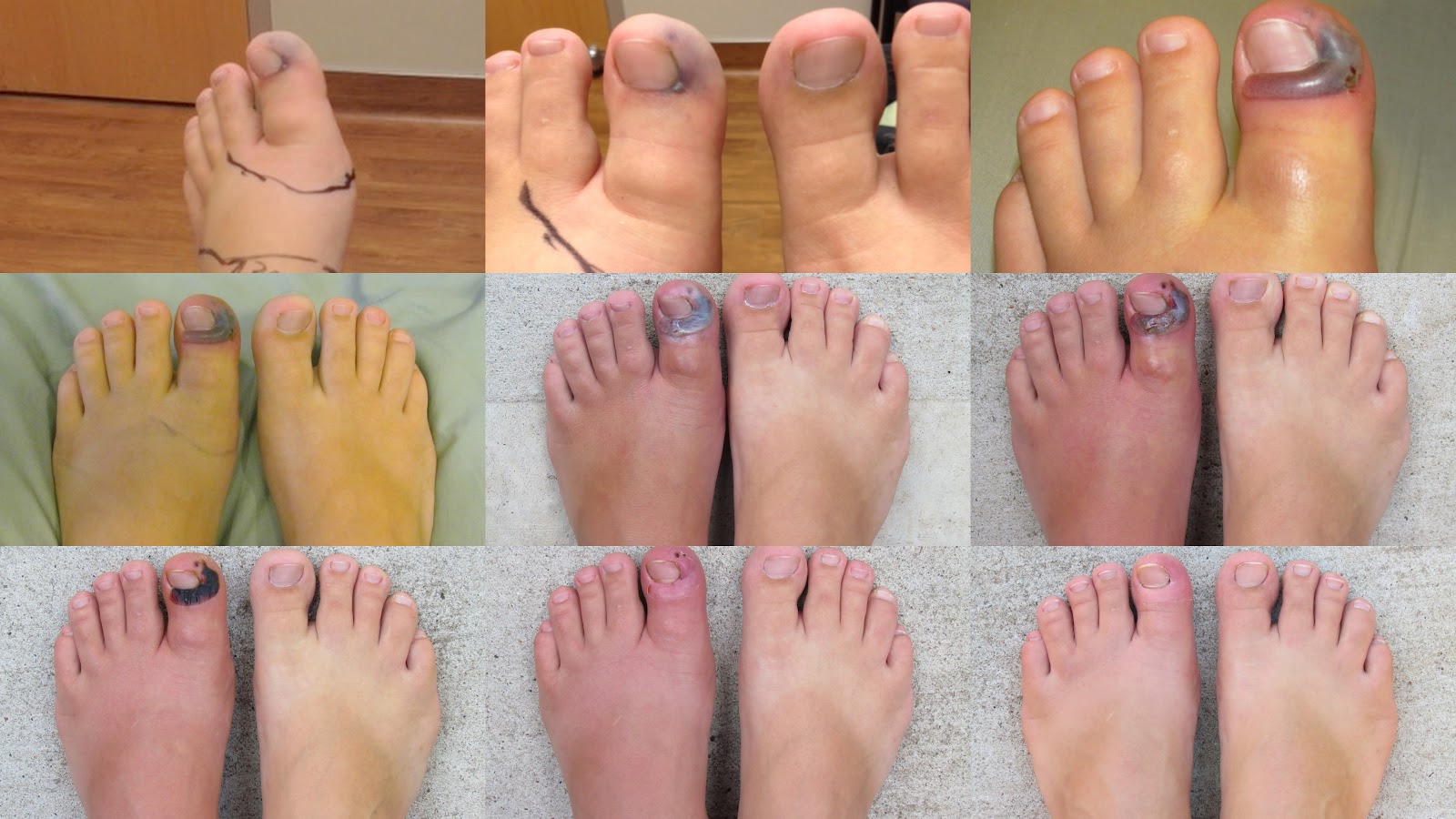 Portage River Haven THE HEALING OF A SNAKE BIT TOE