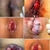 APA SAJA PENYEBAB WASIR? thumbnail