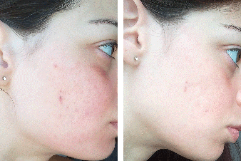 Active Clear Natural Acne Treatment Reviews Active Clear Natural Acne Treatment Reviews
