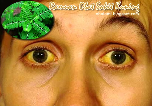 ramuan obat alami untuk mengobati sakit kuning hepatitis ramuan obat alami untuk mengobati sakit kuning hepatitis