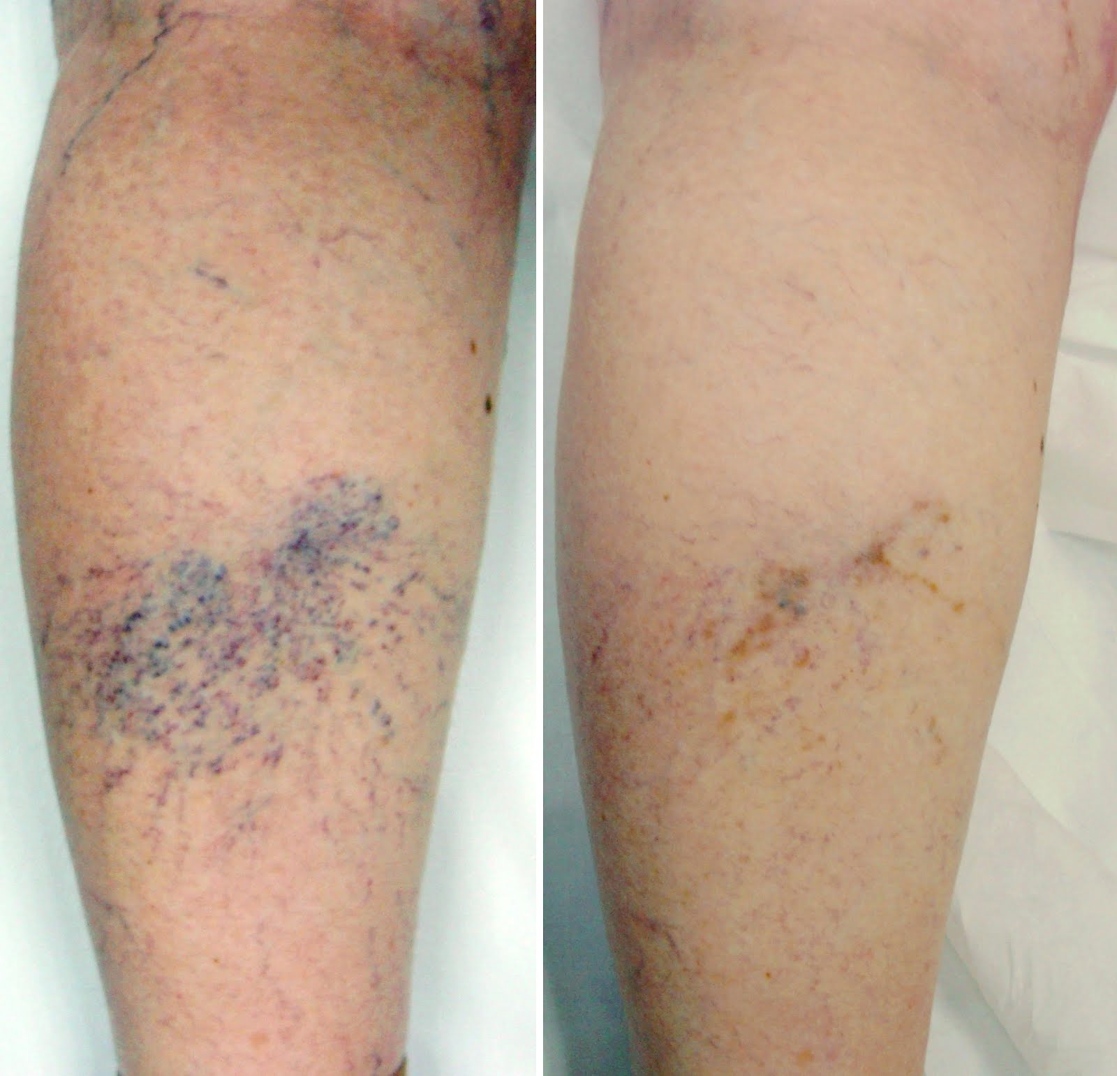 Láser en Problemas de Varices de Afectación Estética Láser en Problemas de Varices de Afectación Estética