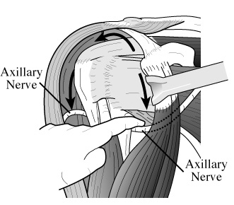 Shoulder Arthritis / Rotator Cuff Tears: causes of shoulder pain