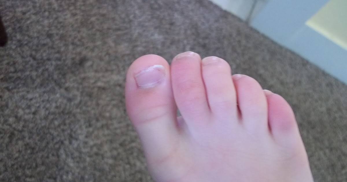 The Thrifty Housewife: An Old Fashioned Ailment- Chilblains - And how