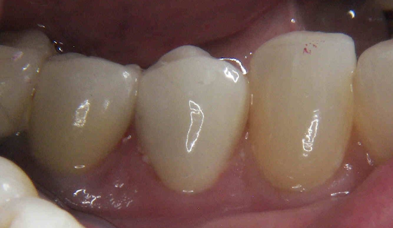 Dentistry for South Orange County Lava All Ceramic Zirconia Crown
