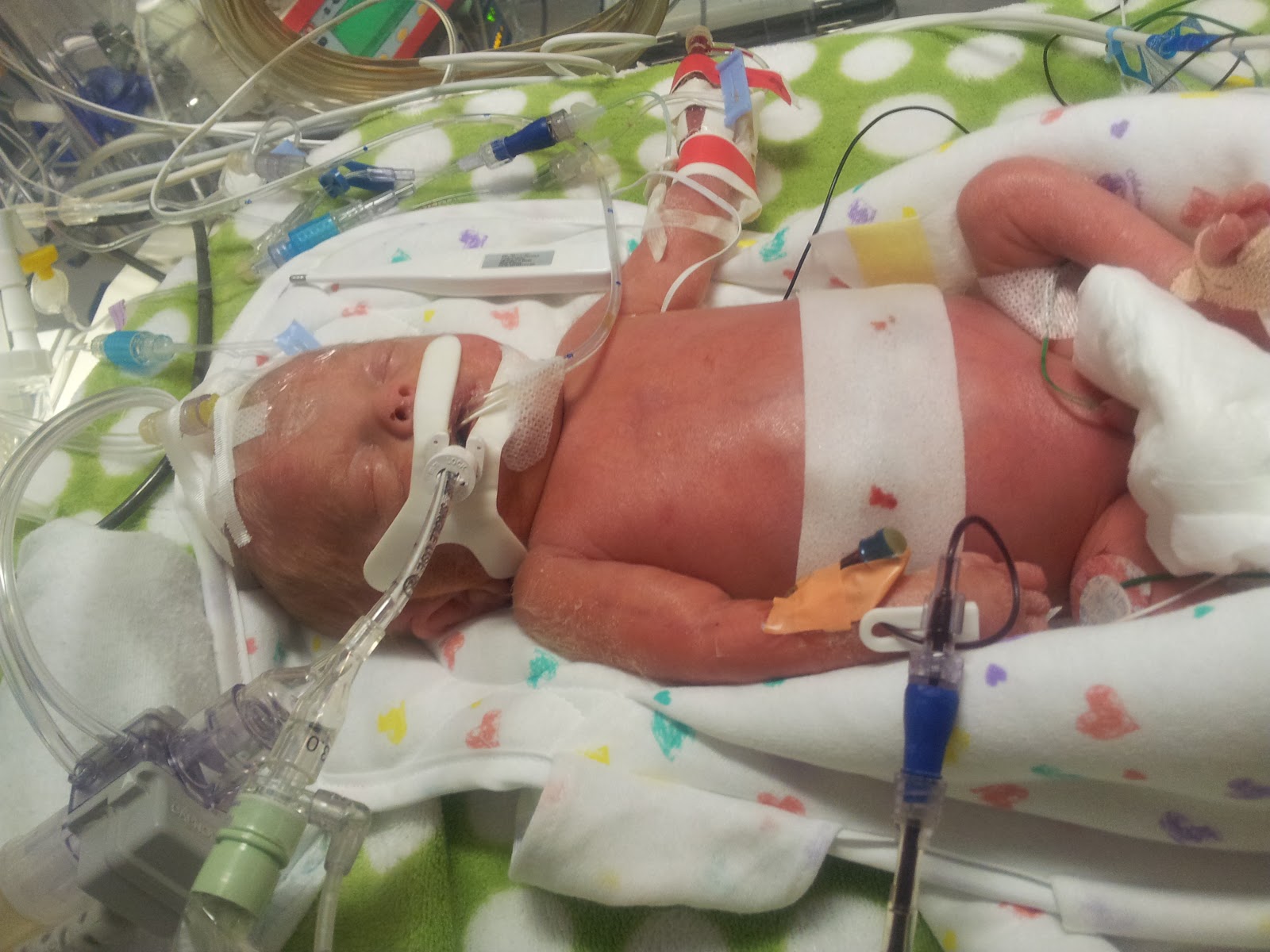 Perforated+Bowel+Surgery+Recovery+Time Three E Circus: Baby Eagan - NICU Day 27-30 - Surgery and Recovery