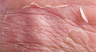 picture of Eczema
