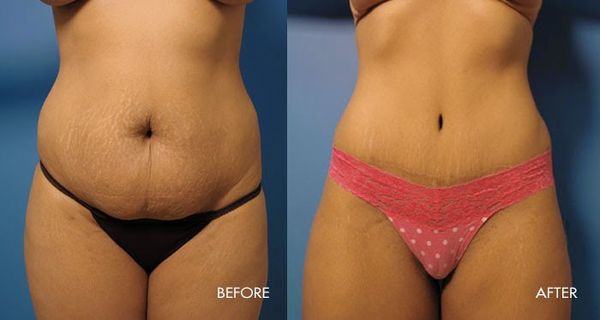 Natural Recipe To Lose 7 Kilos Of Weight Without Diet weight loss before and after