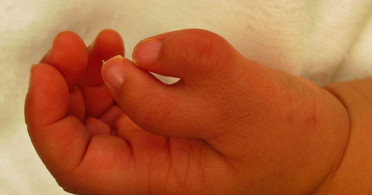 Extra Thumb Congenital Hand and Arm Differences