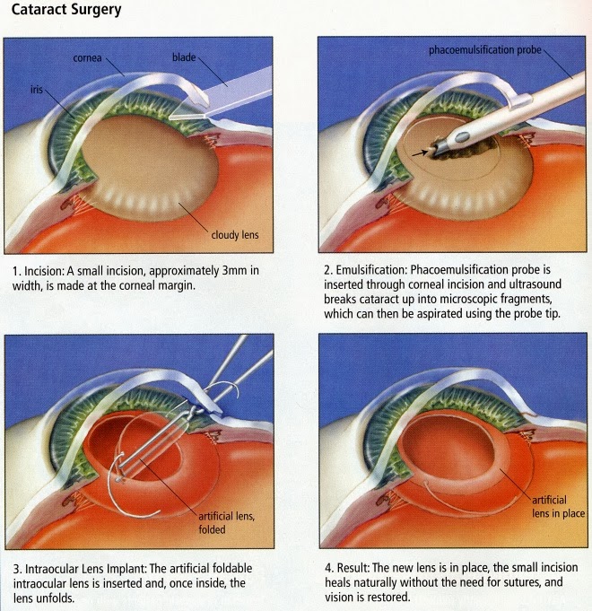 Cialis After Eye Surgery