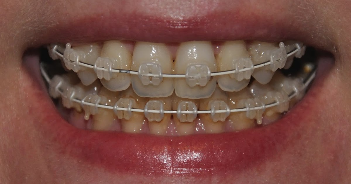 Things that make me go aagghh! Nine months of braces