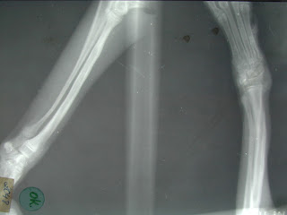fractura espiroidea pico flauta cubito radiot fractura huesos largos