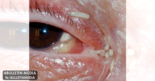 MENGERIKAN Ulat Keluar Dari Hidung Dan Kelopak Mata Wanita - Bulletin Media